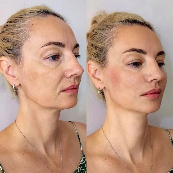 Jawline Definition & Lift