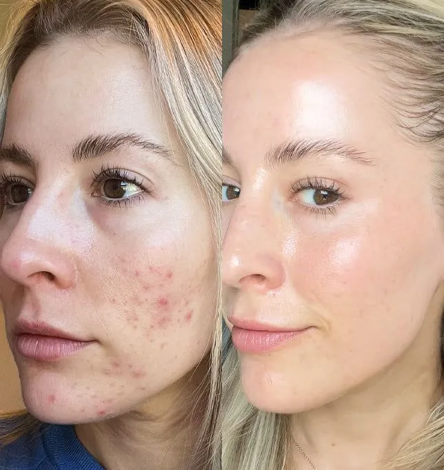 Acne Clear Skin Control