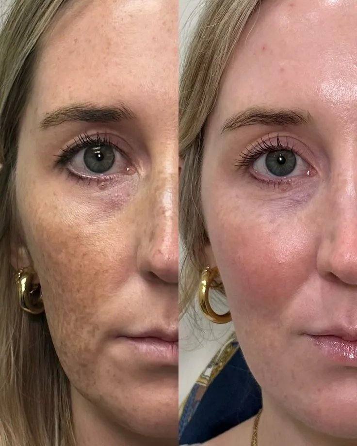 Pigmentation Correction
