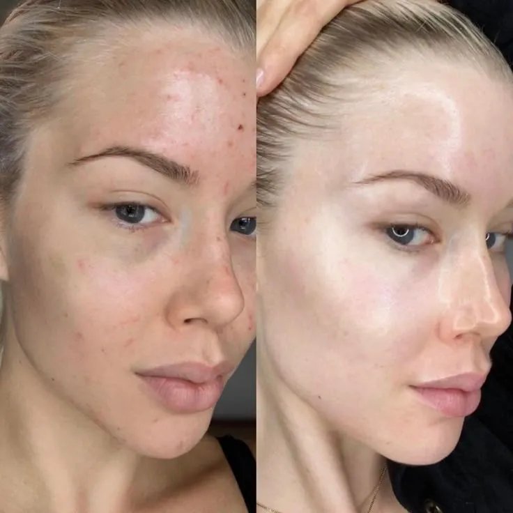 Dermapen Before After