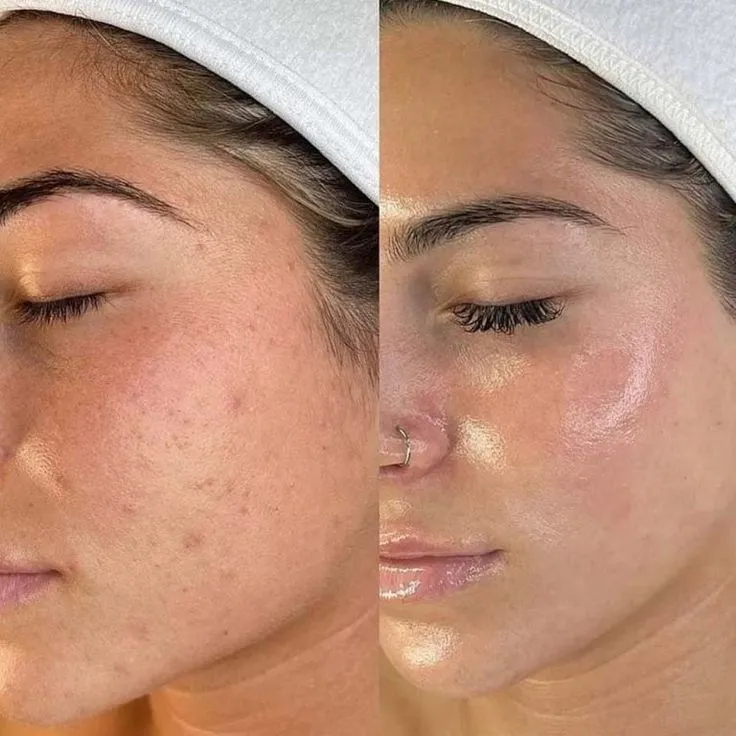 Hydrafacial Before After